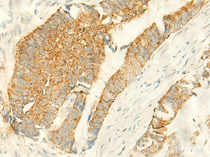 Immunohistochemistry of paraffin-embedded Human colorectal cancer tissue using MPV17 Polyclonal Antibody at dilution of 1:50 (×200)