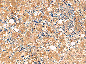 Immunohistochemistry of paraffin-embedded Human liver cancer tissue using FUNDC2 Polyclonal Antibody at dilution of 1:60 (×200)