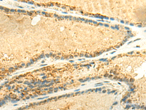 Immunohistochemistry of paraffin-embedded Human thyroid cancer tissue using EEF1AKMT2 Polyclonal Antibody at dilution of 1:50 (×200)
