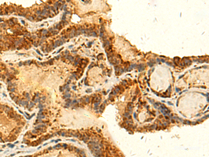 Immunohistochemistry of paraffin-embedded Human thyroid cancer tissue using HS1BP3 Polyclonal Antibody at dilution of 1:50 (×200)