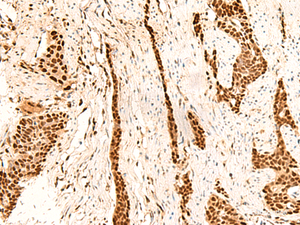 Immunohistochemistry of paraffin-embedded Human esophagus cancer tissue using METTL1 Polyclonal Antibody at dilution of 1:55 (×200)