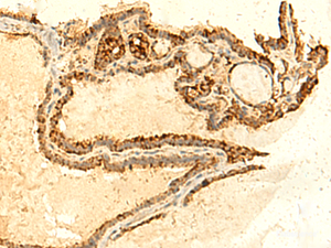 Immunohistochemistry of paraffin-embedded Human thyroid cancer tissue using UNKL Polyclonal Antibody at dilution of 1:50 (×200)