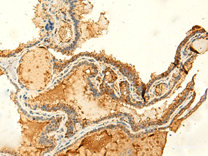 Immunohistochemistry of paraffin-embedded Human thyroid cancer tissue using KIAA0513 Polyclonal Antibody at dilution of 1:50 (×200)