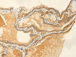 Immunohistochemistry of paraffin-embedded Human thyroid cancer tissue using RNF148 Polyclonal Antibody at dilution of 1:50 (×200)