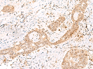 Immunohistochemistry of paraffin-embedded Human esophagus cancer tissue using PRKAG2 Polyclonal Antibody at dilution of 1:55 (×200)