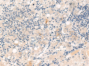 Immunohistochemistry of paraffin-embedded Human liver cancer tissue using CYYR1 Polyclonal Antibody at dilution of 1:55 (×200)