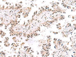 Immunohistochemistry of paraffin-embedded Human lung cancer tissue using KCTD13 Polyclonal Antibody at dilution of 1:50 (×200)