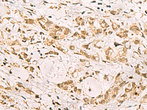 Immunohistochemistry of paraffin-embedded Human gastric cancer tissue using PDS5A Polyclonal Antibody at dilution of 1:90 (×200)