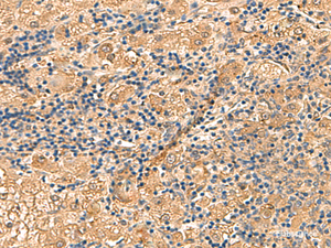 Immunohistochemistry of paraffin-embedded Human liver cancer tissue using PTH1R Polyclonal Antibody at dilution of 1:55 (×200)