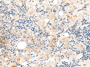 Immunohistochemistry of paraffin-embedded Human liver cancer tissue using DUT Polyclonal Antibody at dilution of 1:60 (×200)