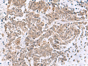 Immunohistochemistry of paraffin-embedded Human lung cancer tissue using RBFOX2 Polyclonal Antibody at dilution of 1:50 (×200)