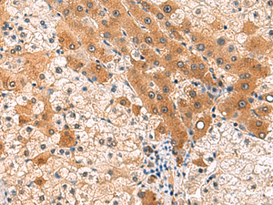 Immunohistochemistry of paraffin-embedded Human liver cancer tissue using PCYT2 Polyclonal Antibody at dilution of 1:85 (×200)