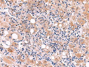 Immunohistochemistry of paraffin-embedded Human liver cancer tissue using LIPA Polyclonal Antibody at dilution of 1:50 (×200)