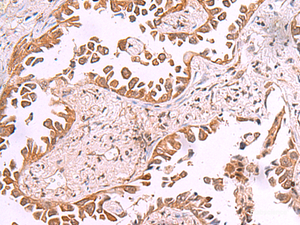 Immunohistochemistry of paraffin-embedded Human lung cancer tissue using AK9 Polyclonal Antibody at dilution of 1:85 (×200)
