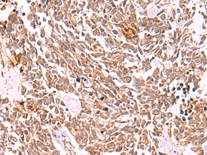 Immunohistochemistry of paraffin-embedded Human lung cancer tissue using COPS3 Polyclonal Antibody at dilution of 1:50 (×200)