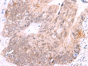 Immunohistochemistry of paraffin-embedded Human colorectal cancer tissue using ASTN2 Polyclonal Antibody at dilution of 1:55 (×200)