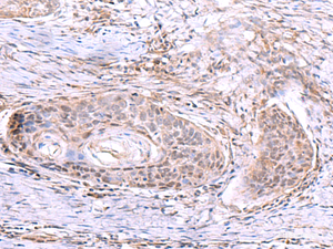 Immunohistochemistry of paraffin-embedded Human esophagus cancer tissue using AKAP17A Polyclonal Antibody at dilution of 1:80 (×200)