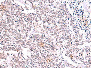 Immunohistochemistry of paraffin-embedded Human lung cancer tissue using TRMT12 Polyclonal Antibody at dilution of 1:85 (×200)