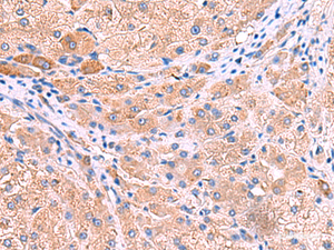 Immunohistochemistry of paraffin-embedded Human liver cancer tissue using MPP1 Polyclonal Antibody at dilution of 1:50 (×200)