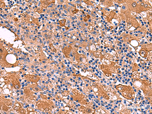 Immunohistochemistry of paraffin-embedded Human liver cancer tissue using FUCA2 Polyclonal Antibody at dilution of 1:80 (×200)