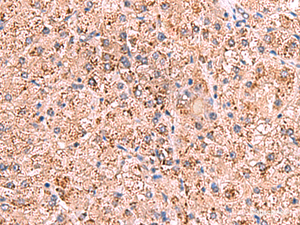 Immunohistochemistry of paraffin-embedded Human liver cancer tissue using OSBPL2 Polyclonal Antibody at dilution of 1:65 (×200)
