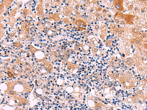 Immunohistochemistry of paraffin-embedded Human liver cancer tissue using KATNAL1 Polyclonal Antibody at dilution of 1:80 (×200)