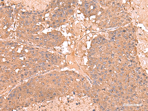 Immunohistochemistry of paraffin-embedded Human liver cancer tissue using AHCYL1 Polyclonal Antibody at dilution of 1:65 (×200)
