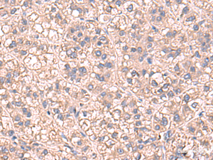 Immunohistochemistry of paraffin-embedded Human liver cancer tissue using SARS Polyclonal Antibody at dilution of 1:60 (×200)