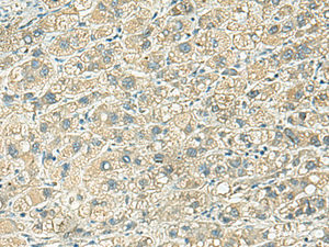 Immunohistochemistry of paraffin-embedded Human liver cancer tissue using KLC2 Polyclonal Antibody at dilution of 1:100 (×200)