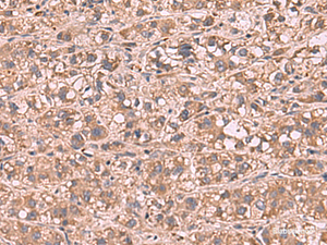 Immunohistochemistry of paraffin-embedded Human liver cancer tissue using SHC4 Polyclonal Antibody at dilution of 1:90 (×200)