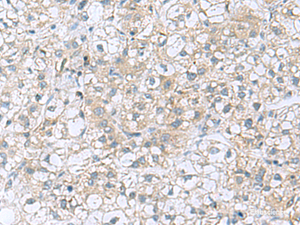 Immunohistochemistry of paraffin-embedded Human liver cancer tissue using TRO Polyclonal Antibody at dilution of 1:80 (×200)