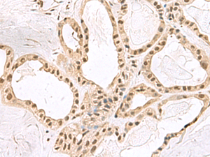 Immunohistochemistry of paraffin-embedded Human thyroid cancer tissue using PCLAF Polyclonal Antibody at dilution of 1:60 (×200)