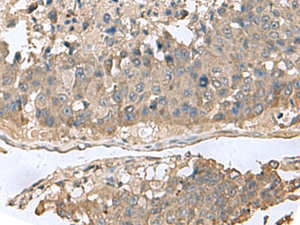 Immunohistochemistry of paraffin-embedded Human liver cancer tissue using GABARAPL2 Polyclonal Antibody at dilution of 1:60 (×200)