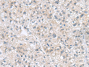 Immunohistochemistry of paraffin-embedded Human liver cancer tissue using GEMIN7 Polyclonal Antibody at dilution of 1:70 (×200)