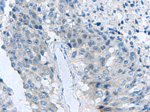 Immunohistochemistry of paraffin-embedded Human liver cancer tissue using MED31 Polyclonal Antibody at dilution of 1:140 (×200)