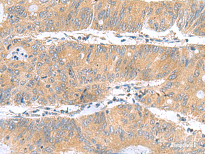 Immunohistochemistry of paraffin-embedded Human colorectal cancer tissue using DNAL1 Polyclonal Antibody at dilution of 1:50 (×200)