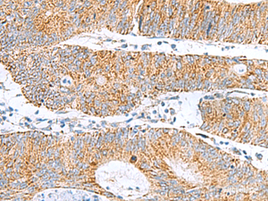 Immunohistochemistry of paraffin-embedded Human colorectal cancer tissue using GCSH Polyclonal Antibody at dilution of 1:60 (×200)