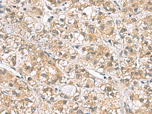 Immunohistochemistry of paraffin-embedded Human liver cancer tissue using PPIH Polyclonal Antibody at dilution of 1:70 (×200)