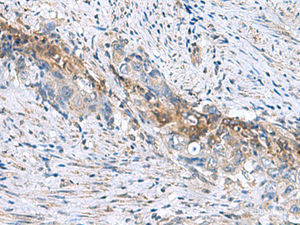 Immunohistochemistry of paraffin-embedded Human cervical cancer tissue using RNF208 Polyclonal Antibody at dilution of 1:55 (×200)