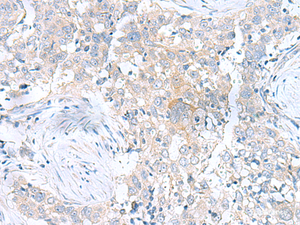 Immunohistochemistry of paraffin-embedded Human esophagus cancer tissue using UBE2F Polyclonal Antibody at dilution of 1:100 (×200)