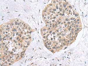 Immunohistochemistry of paraffin-embedded Human esophagus cancer tissue using RPL18 Polyclonal Antibody at dilution of 1:60 (×200)