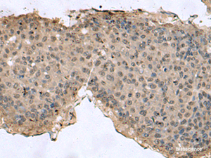 Immunohistochemistry of paraffin-embedded Human liver cancer tissue using TMX3 Polyclonal Antibody at dilution of 1:60 (×200)