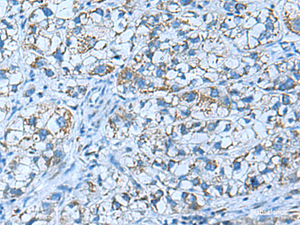 Immunohistochemistry of paraffin-embedded Human liver cancer tissue using GUCA1A Polyclonal Antibody at dilution of 1:50 (×200)