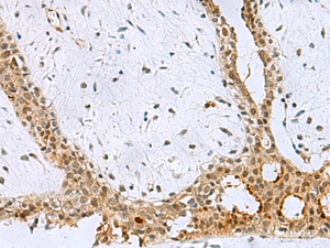 Immunohistochemistry of paraffin-embedded Human breast cancer tissue using BCL7B Polyclonal Antibody at dilution of 1:60 (×200)