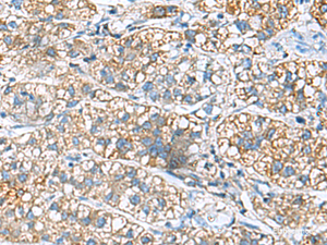 Immunohistochemistry of paraffin-embedded Human liver cancer tissue using JOSD1 Polyclonal Antibody at dilution of 1:90 (×200)