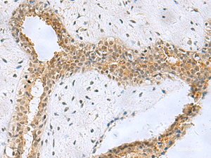 Immunohistochemistry of paraffin-embedded Human breast cancer tissue using NABP1 Polyclonal Antibody at dilution of 1:50 (×200)