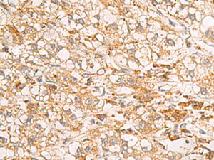 Immunohistochemistry of paraffin-embedded Human liver cancer tissue using RAB38 Polyclonal Antibody at dilution of 1:50 (×200)