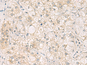 Immunohistochemistry of paraffin-embedded Human liver cancer tissue using LRAT Polyclonal Antibody at dilution of 1:50 (×200)