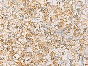 Immunohistochemistry of paraffin-embedded Human liver cancer tissue using HLA-DQB2 Polyclonal Antibody at dilution of 1:70 (×200)