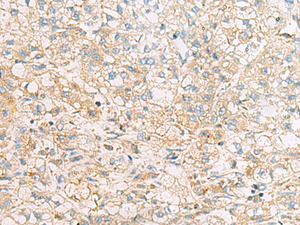 Immunohistochemistry of paraffin-embedded Human liver cancer tissue using EIF4E2 Polyclonal Antibody at dilution of 1:50 (×200)